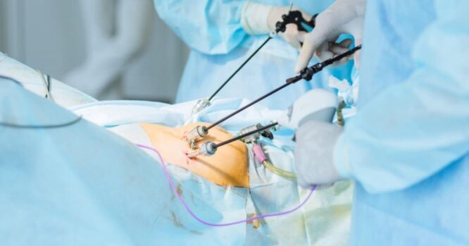 Laparoscopic Surgery: Purpose, Procedure, And Benefits